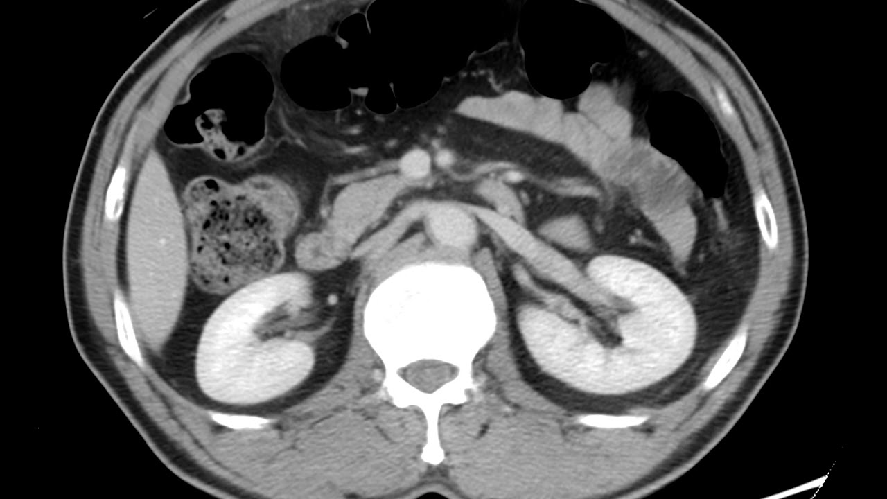 Epiploic appendagitis (Ahuja AT et al; 2017) Book: Essential Radiology