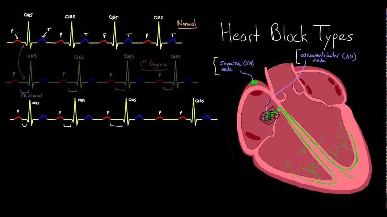 Major Types of Heart Block