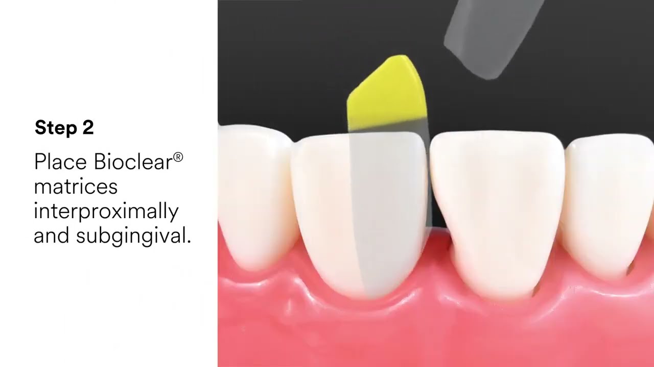 beach cities dentistry 3M&trade; Filtek&trade; Dental Restoratives and Bioclear&reg;