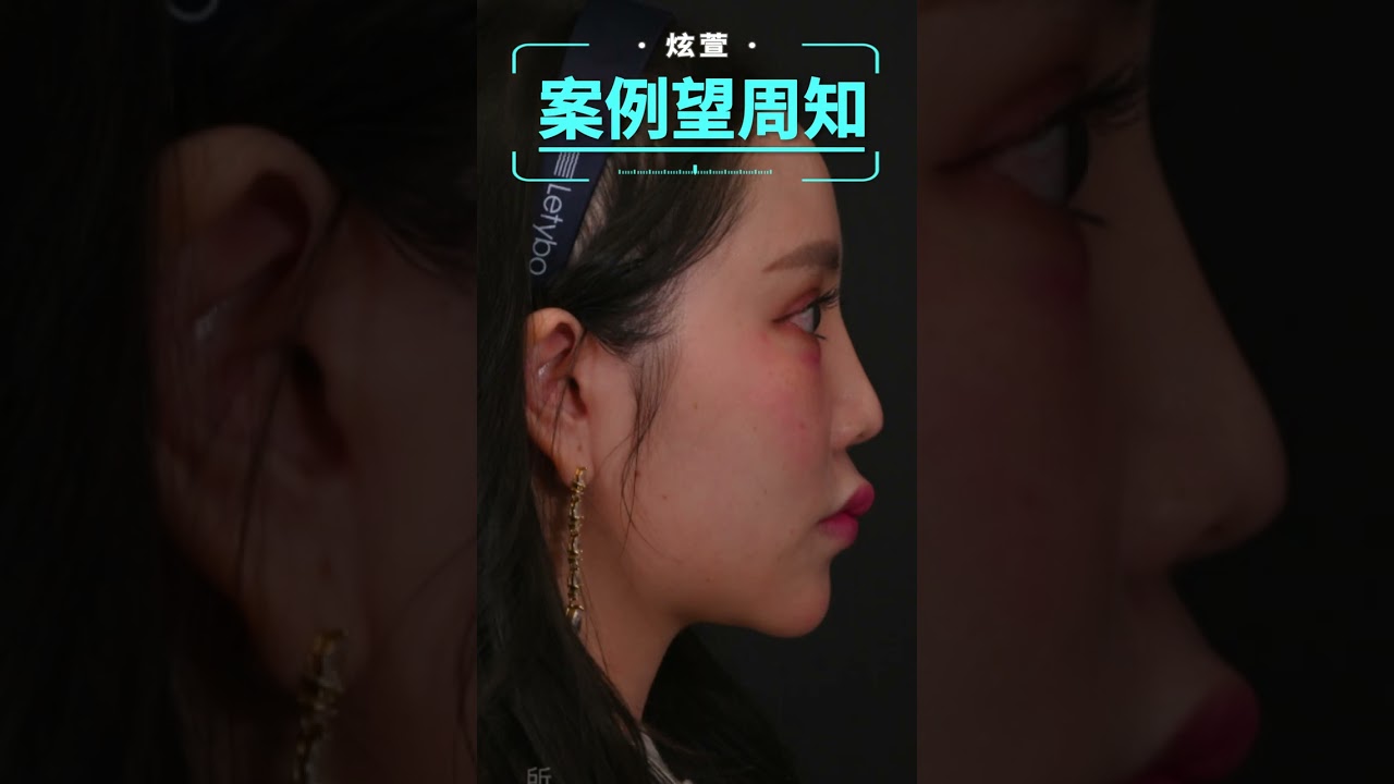 案例望周知 雙下巴＆手臂＆後背 威塑抽脂＋超能電漿