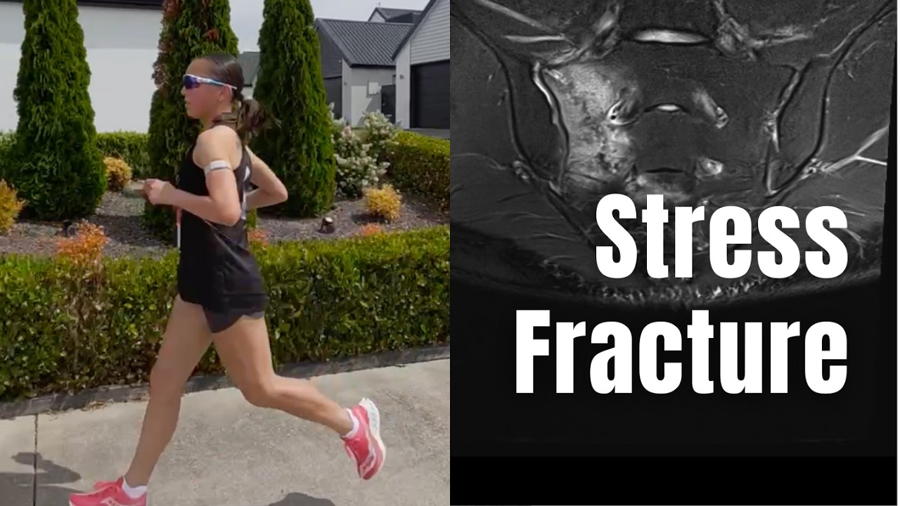 I Was Just Diagnosed With a Sacral Stress Fracture (My First Major Running Injury)