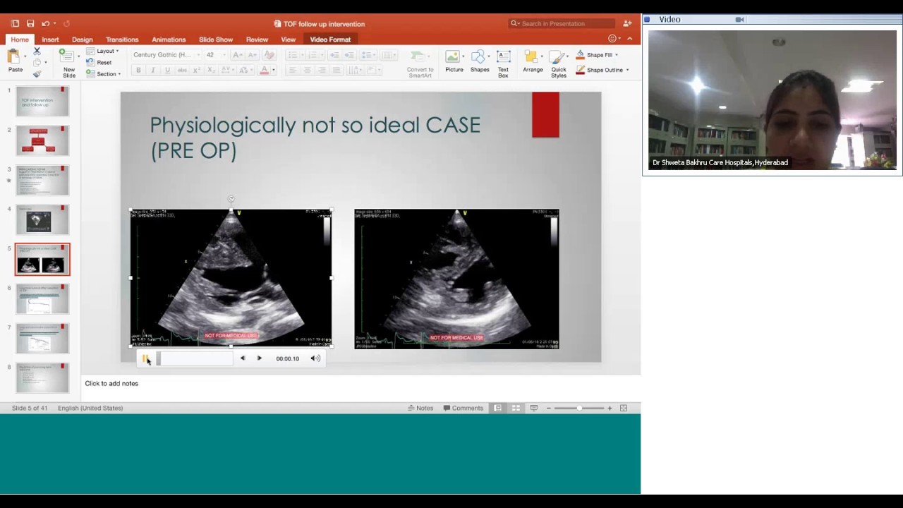 TOF intervention and followup by Dr Shweta Bakhru