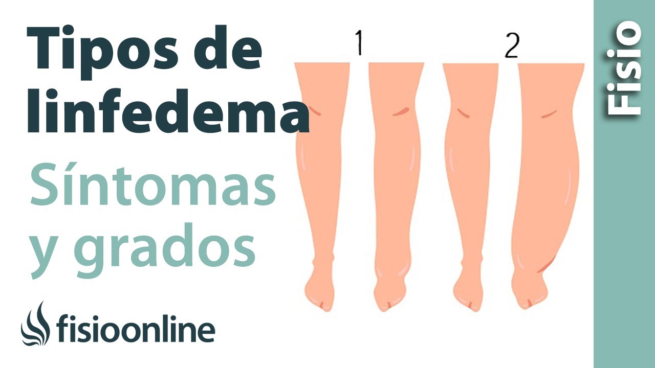 TIPOS de LINFEDEMA, signos CLÍNICOS, ESTADIOS y CAUSAS 🦵🏻