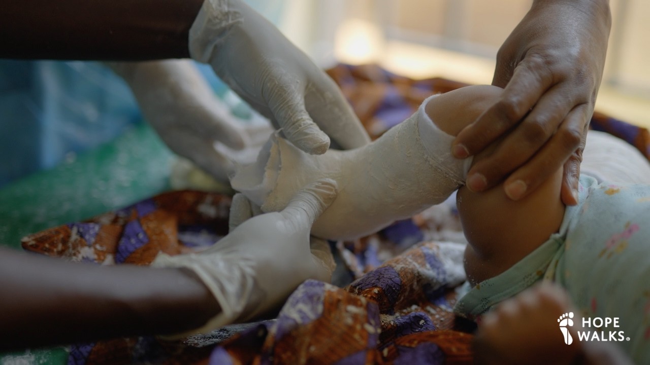 Tuesday 2  - June 2025 - World Clubfoot Day