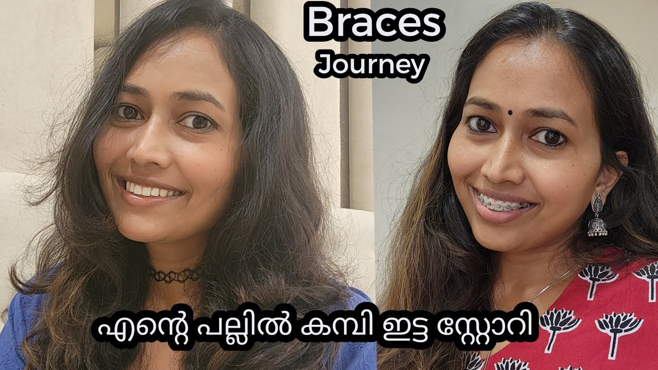 എൻ്റെ പല്ലിൽ കമ്പി ഇട്ട സ്റ്റോറി🦷#braces #bracestreatment #braceslife #bracesupdate #bracesoff