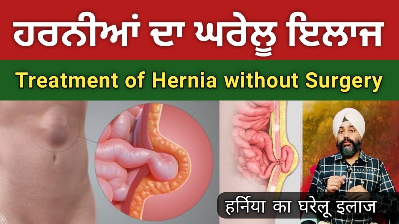 ਹਰਨੀਆਂ ਹੋਣ ਤੇ ਇਵੇਂ ਕਰੋ ਇਲਾਜ ਦੁਬਾਰਾ ਨਹੀਂ ਆਵੇਗੀ ਸਮੱਸਿਆ | हर्निया नही होंगी दुबारा | @dstalanian