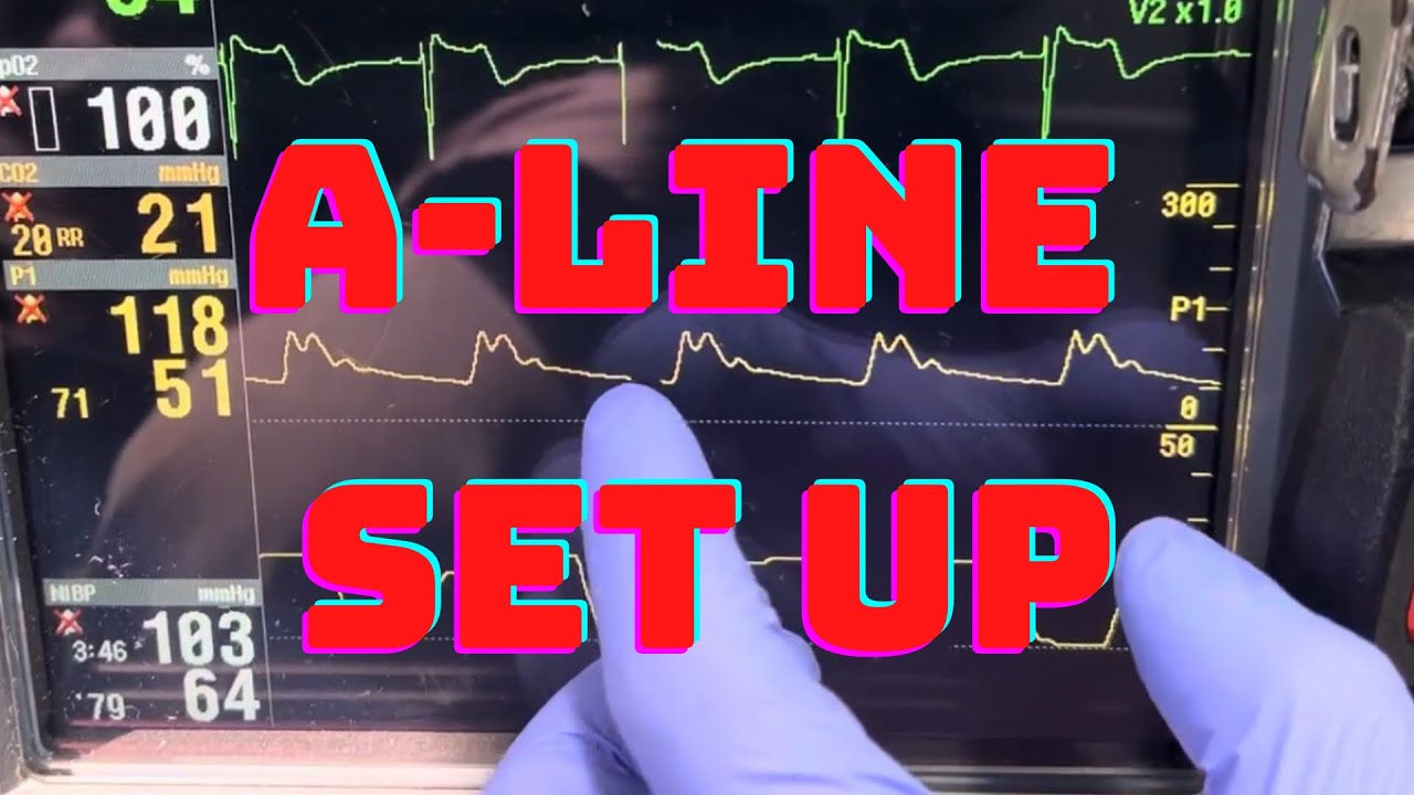 How to Set Up Pressure Transducer for an A-Line with LifePak 15?