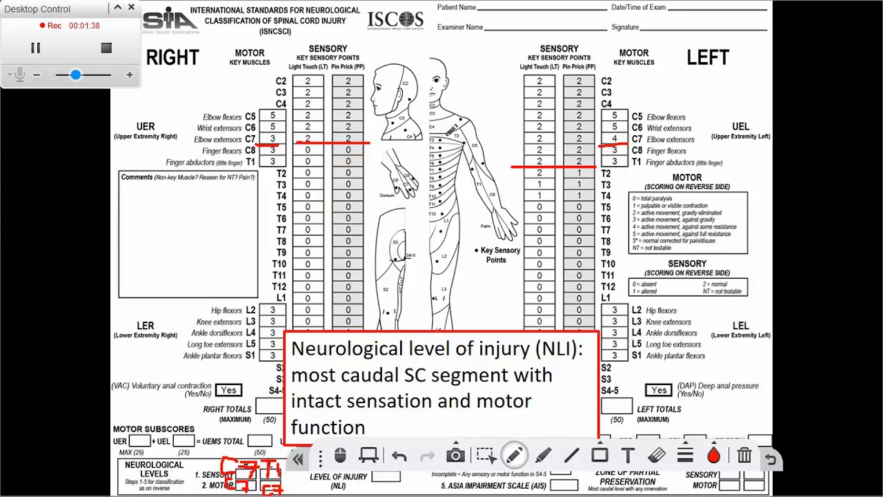 Determining the Neurological Level of Injury (NLI)