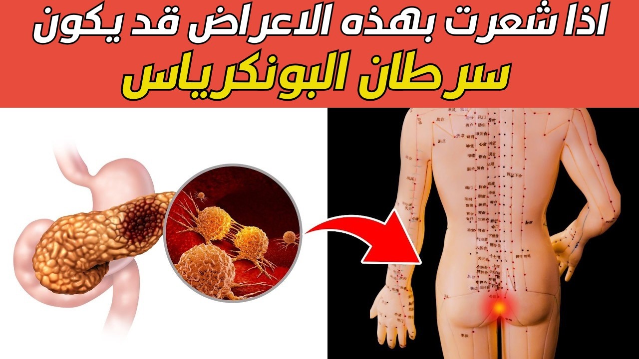 🩺 هل تعاني من هذه الأعراض؟ قد تكون إشارة مبكرة لسرطان البنكرياس!