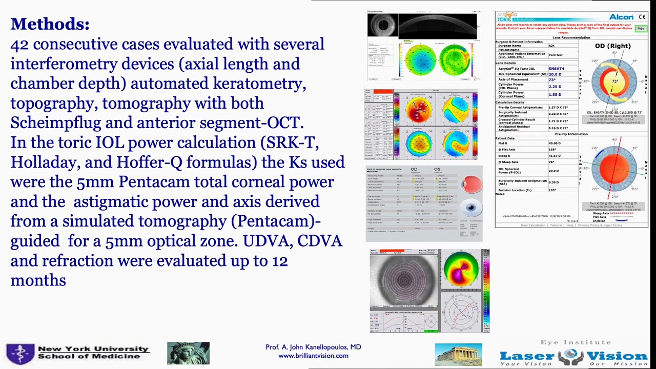 Toric IOL calculation in keratoconus: novel technique: total Pentacam Ks @ 5mm: Kanellopoulos, MD