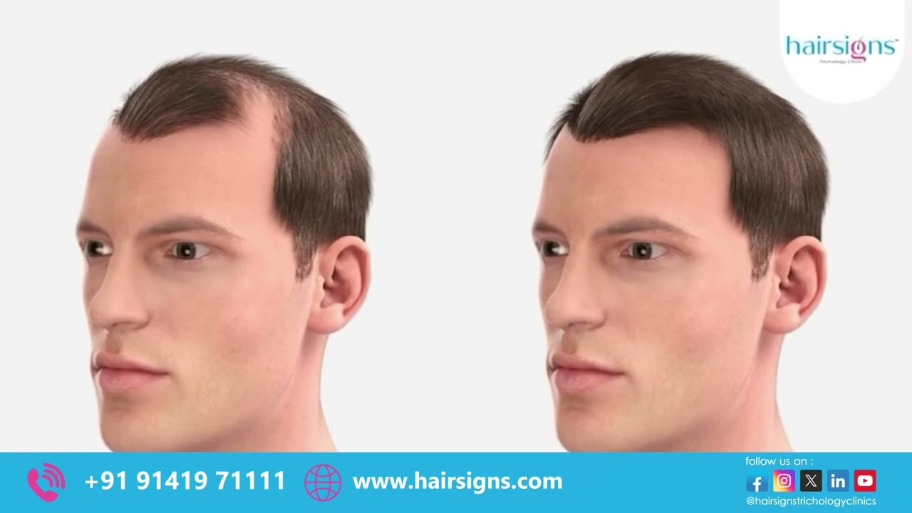 @Hairsigns Hair Transplantation Procedure.