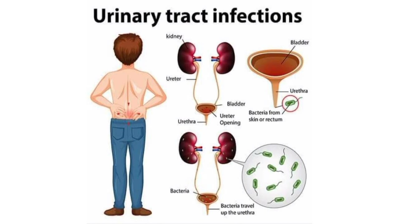 UTI video by life saving Mi