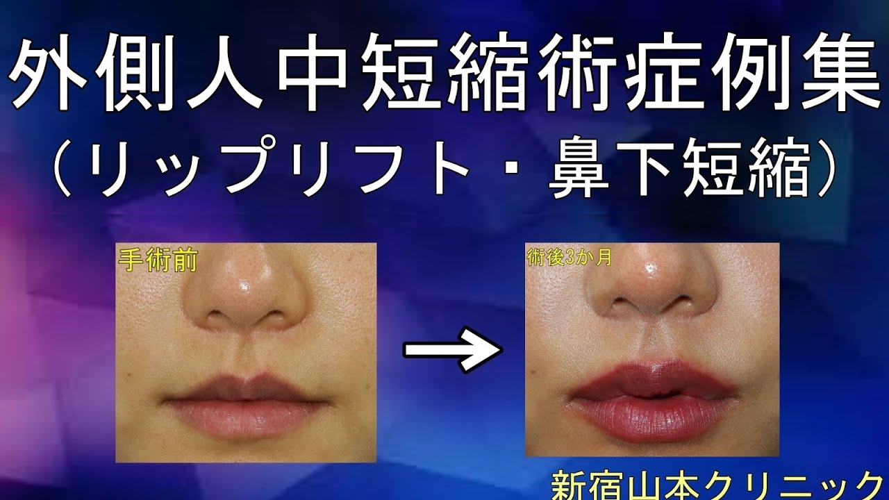 外側人中の経過症例たくさんご紹介します☆新宿　山本クリニック