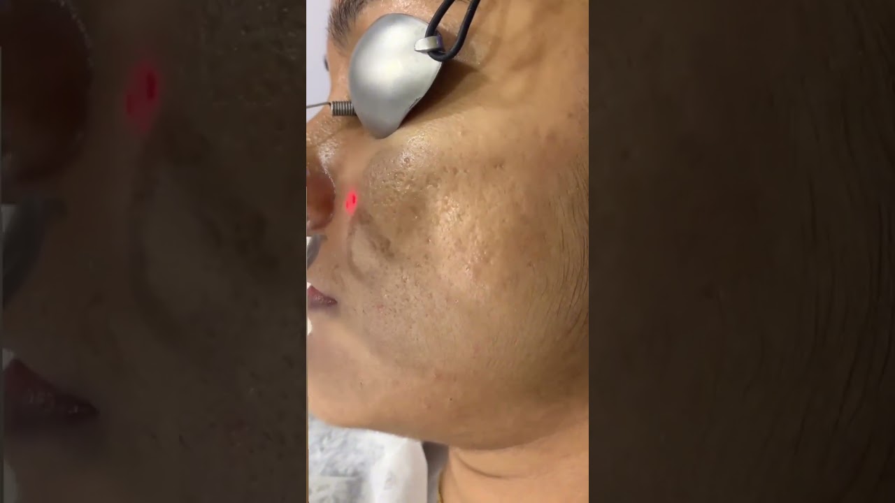 This FRX Treatment Changed My Skin &mdash; Real Results You Need to See! 🔥