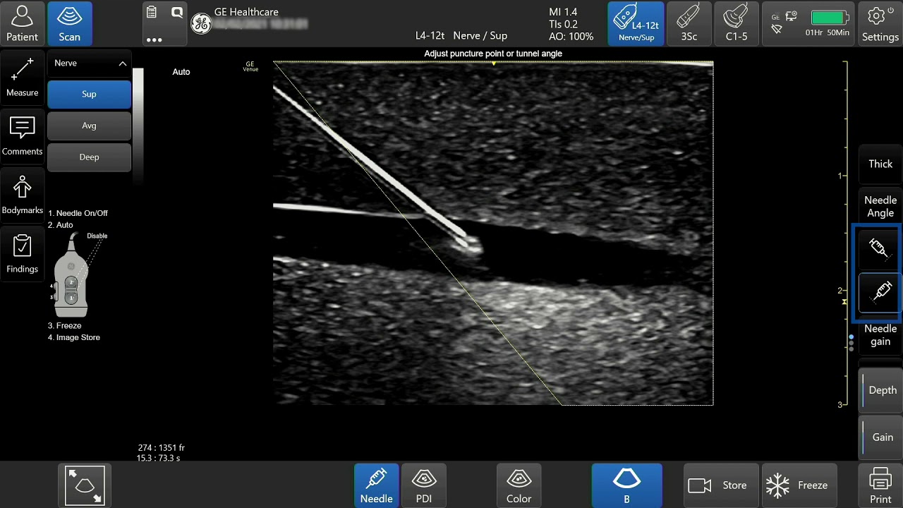 Venue™ Family R3 Tutorial - Needle Visualization