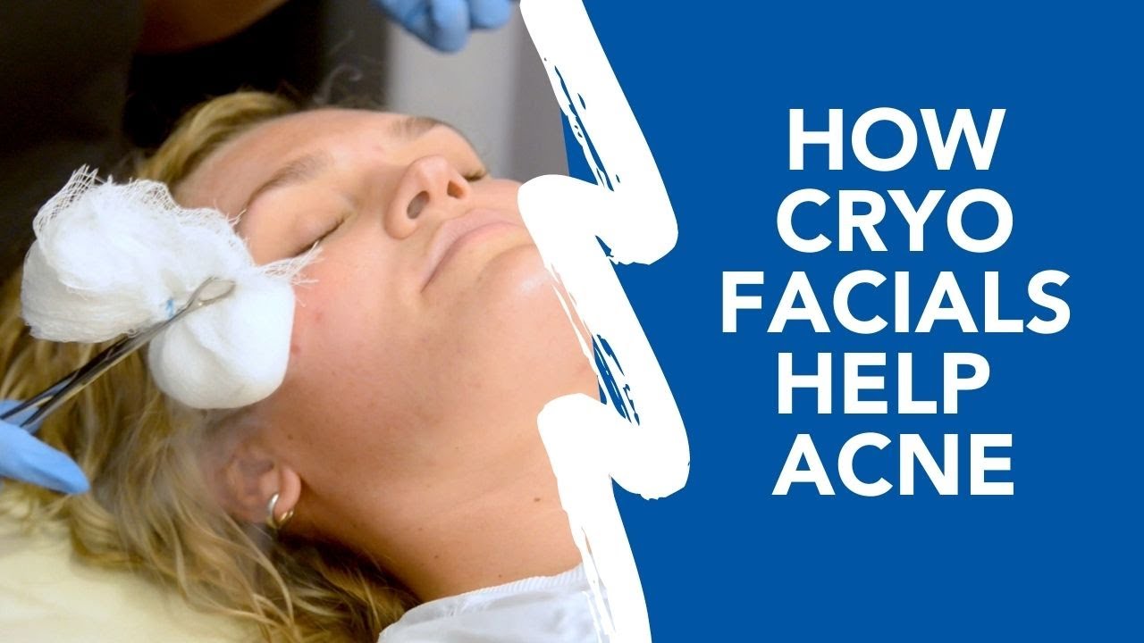 How does a cryo facial help treat acne breakouts?