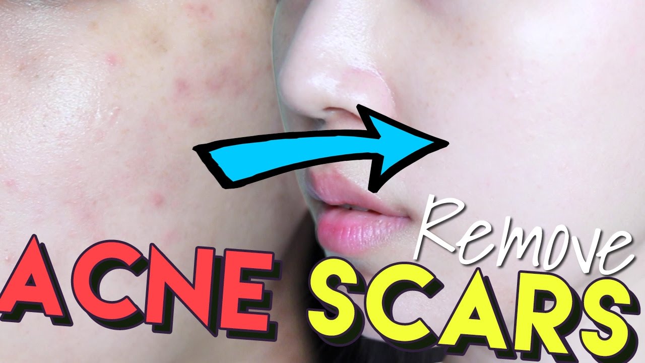 How To Get Rid of Acne Scars & Hyperpigmentation • Get Brighter Skin!