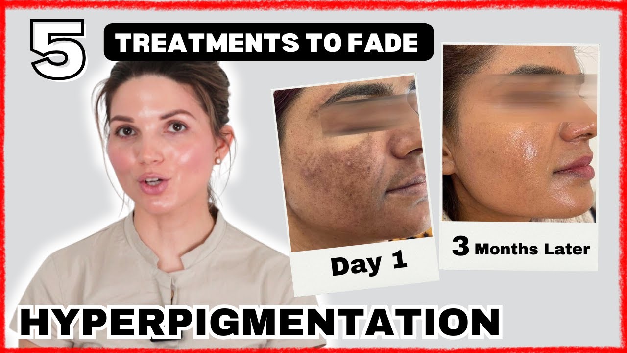 Top 5 Treatments to Fade Hyperpigmentation (2024)