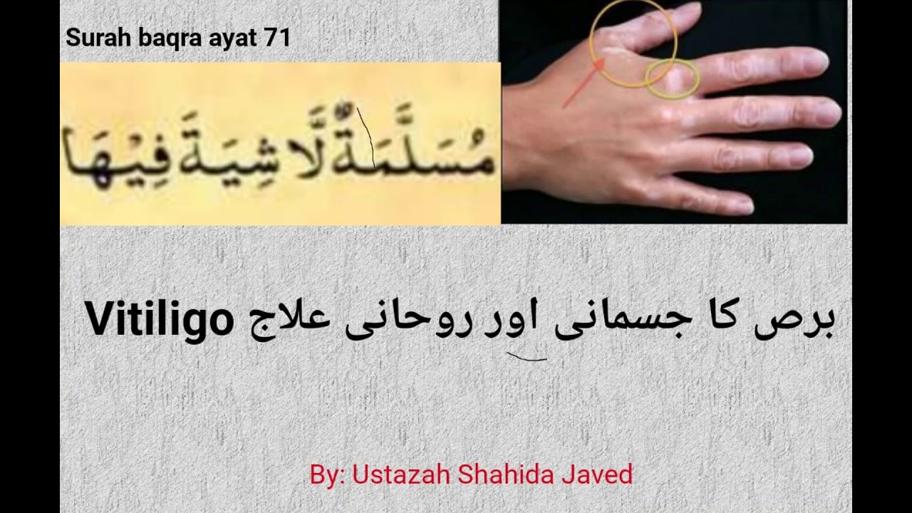Vitiligo برص کا جسمانی اور روحانی علاج