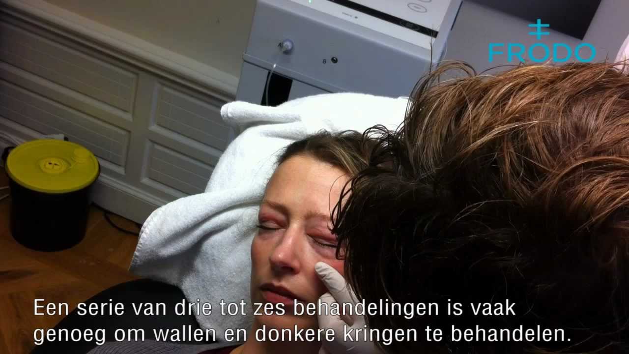 Behandeling Wallen en donkere kringen rond de ogen verbeteren met Carboxytherapie