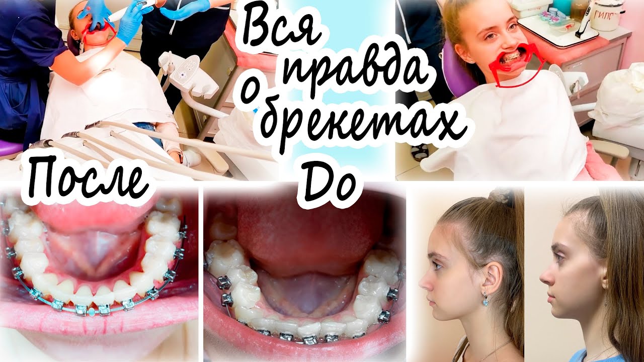 До После 😨 ДОВОЛЬНА ли Я РЕЗУЛЬТАТОМ 👉 ВСЯ ПРАВДА о БРЕКЕТАХ