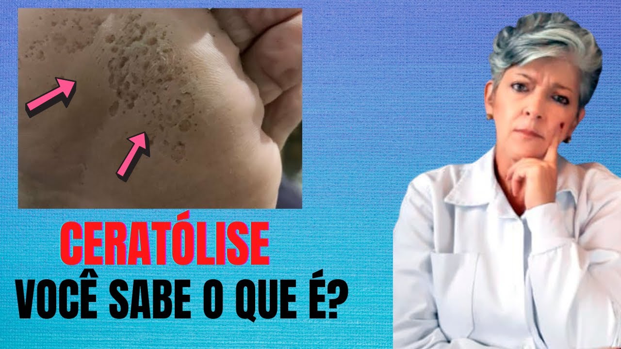Saiba o Que é Ceratólise