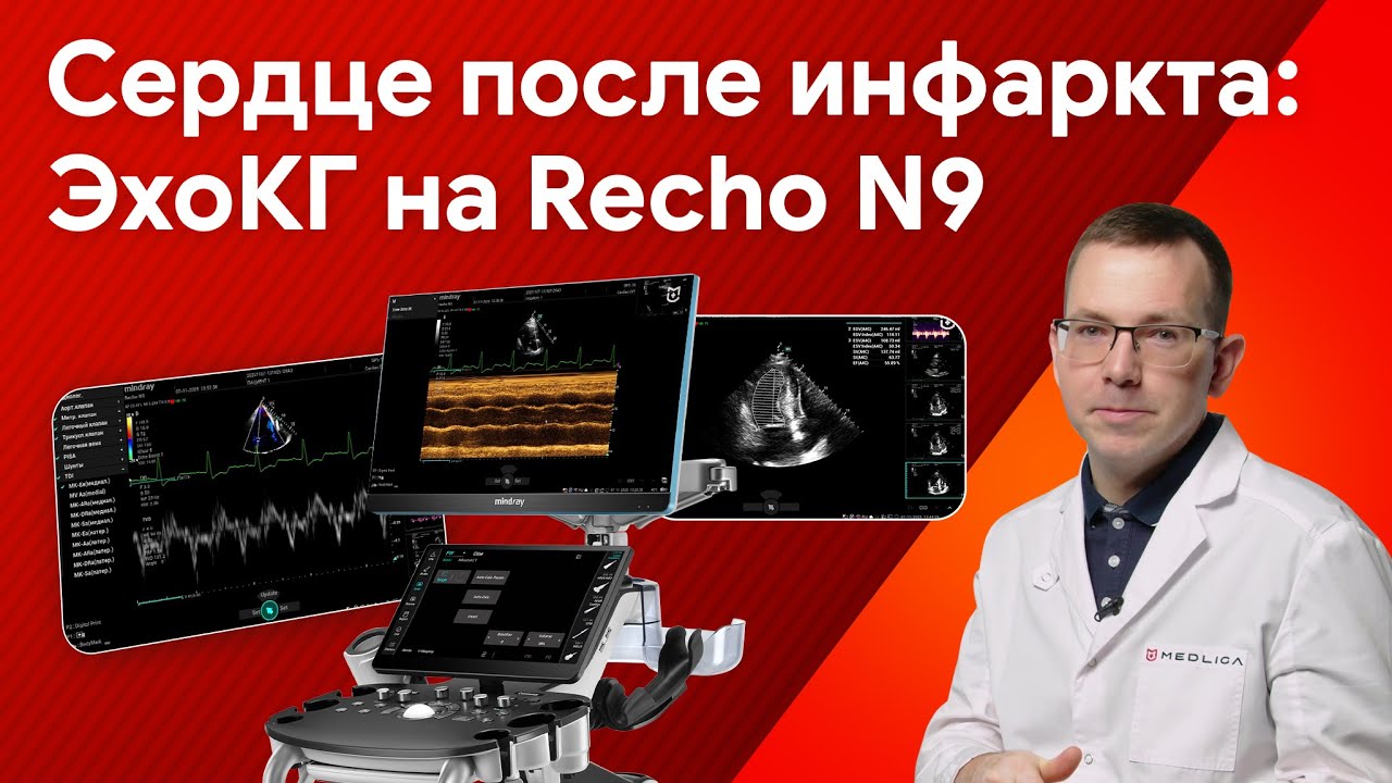 ЭхоКГ пациента после инфаркта с кардиостимулятором на Mindray Recho N9
