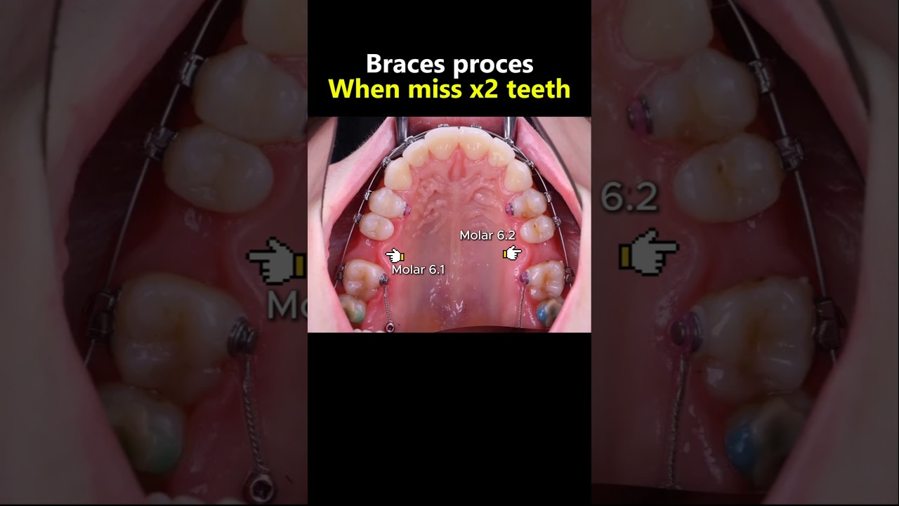Miss x2 molar teeth and braces #dentist #orthodontist #teeth #braces