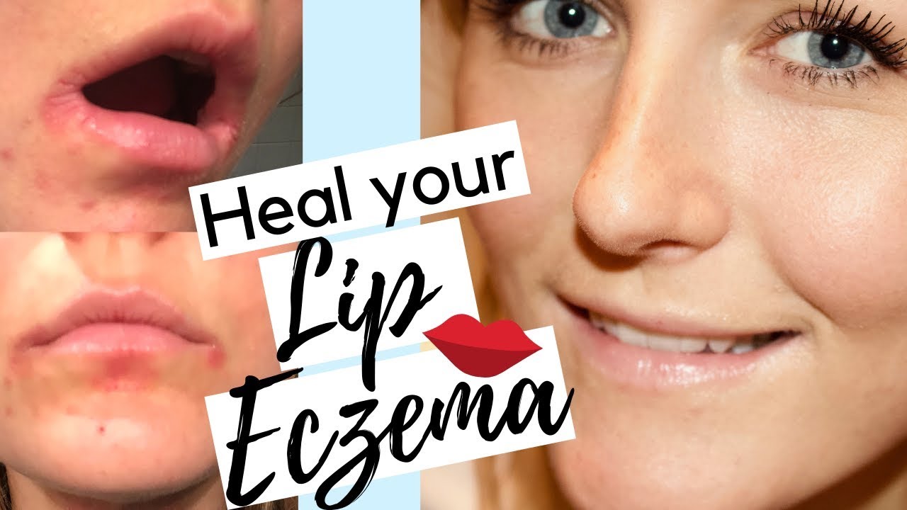 How To Heal Eczema On Lips | How To Treat Lip Eczema Naturally | Lip Eczema Treatment