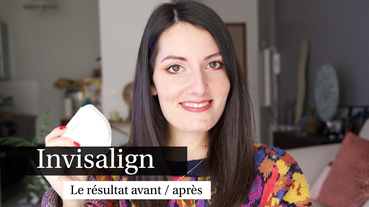 Invisalign le résultat avant / après ( Rendez-vous, Durée, fil de contention ...)