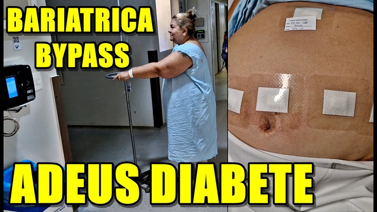 BARIATRICA BAYPESSS AOS 62 ANOS TERCEIRO DIA COMO ESTÁ MINHA RECUPERAÇÃO