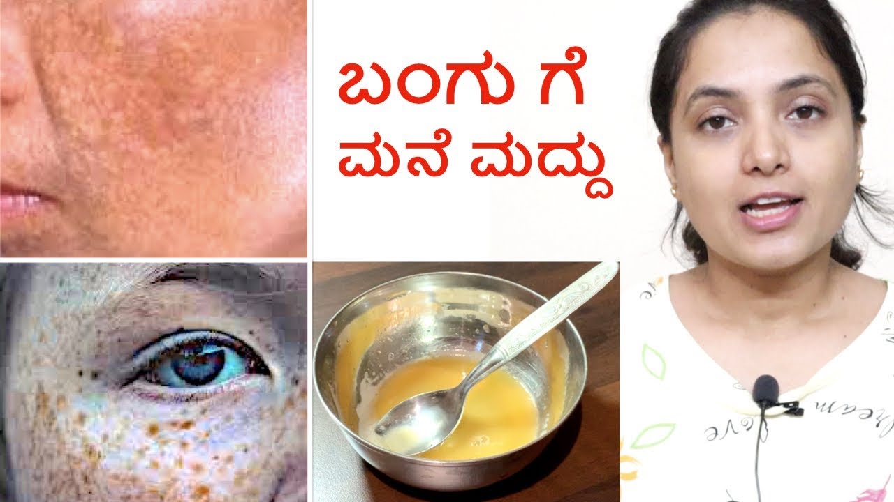 ಬಂಗು ಗೆ  ಮನೆ ಮದ್ದು | Home Remedy For Skin Pigmentation, Dark Spots, Melasma, Blemishes