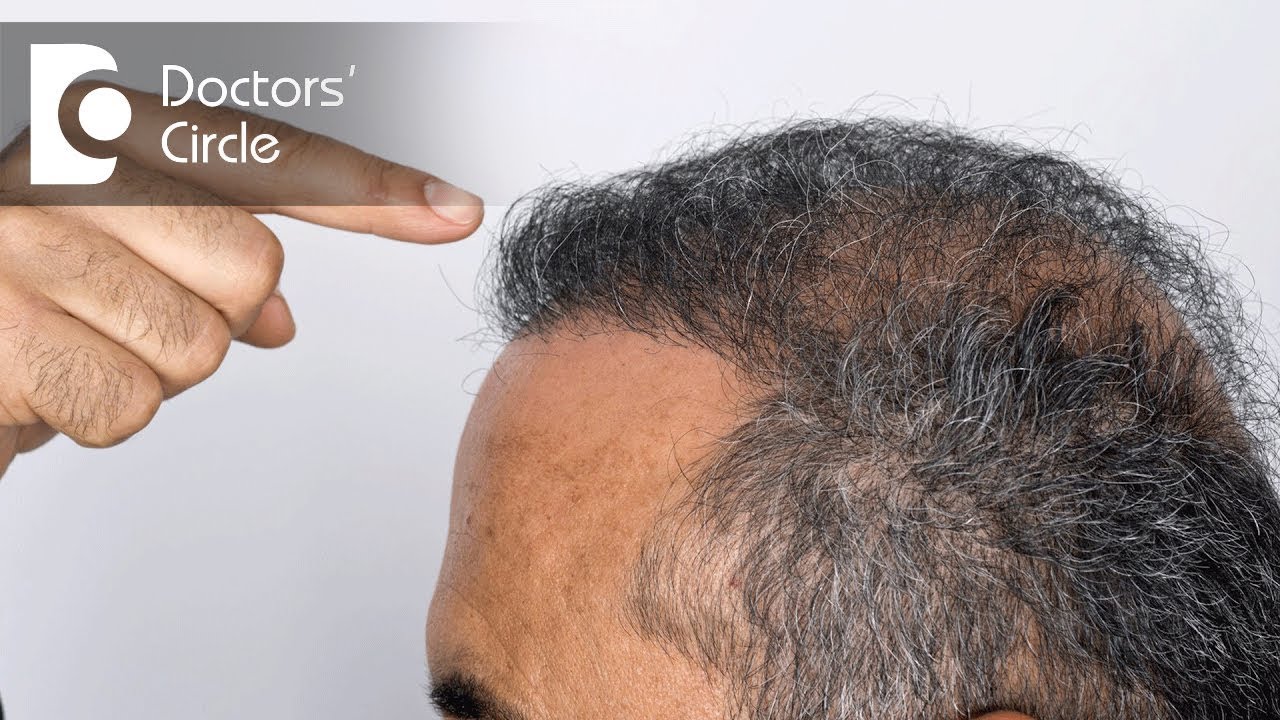 How does hair transplantation work? - Dr. Madan Kumar BJ