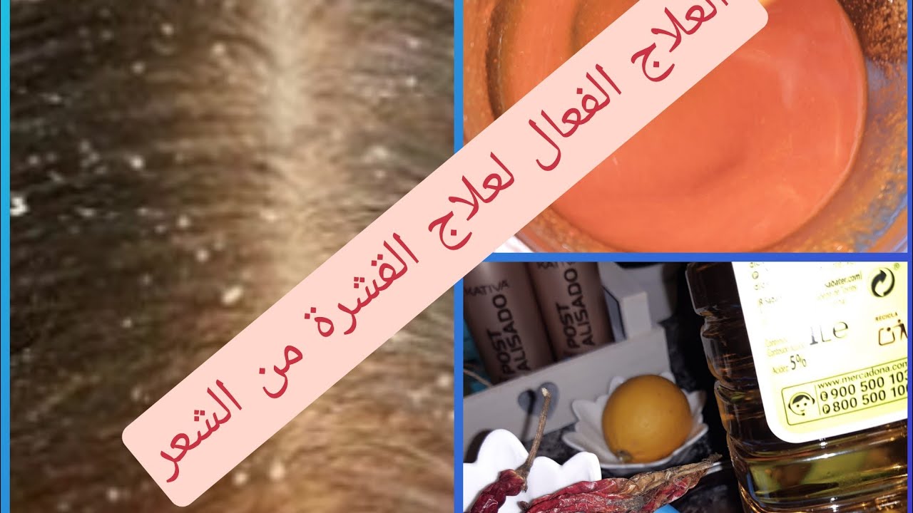 فيك القشرة في الشعر دخلي شوفي وصفة الفلفل  وخل التفاح لازالة قشرة الرأس في يوم واحد