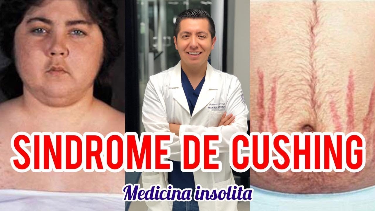 ¡SÍNDROME DE CUSHING! || Medicina Insólita || StoryTime || Caso ENARM || Capitulo 2