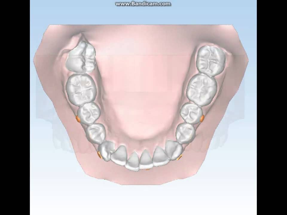 Ortodonzia Invisibile Aurodental 9