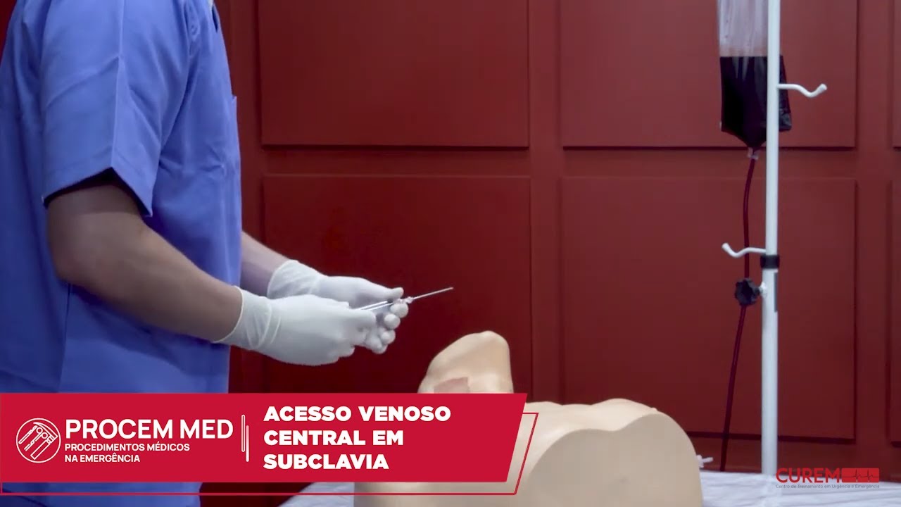 ACESSO VENOSO CENTRAL EM SUBCLAVIA