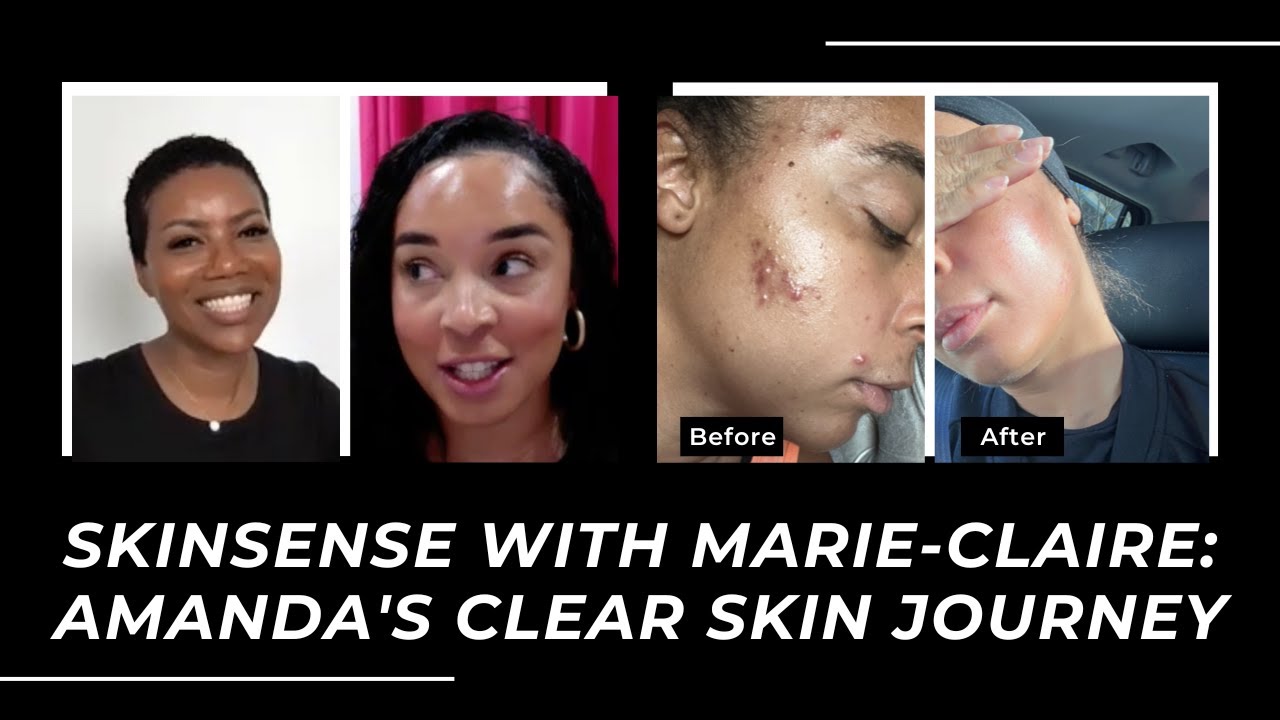 SKINSENSE WITH MARIE-CLAIRE: AMANDA'S CLEAR SKIN JOURNEY