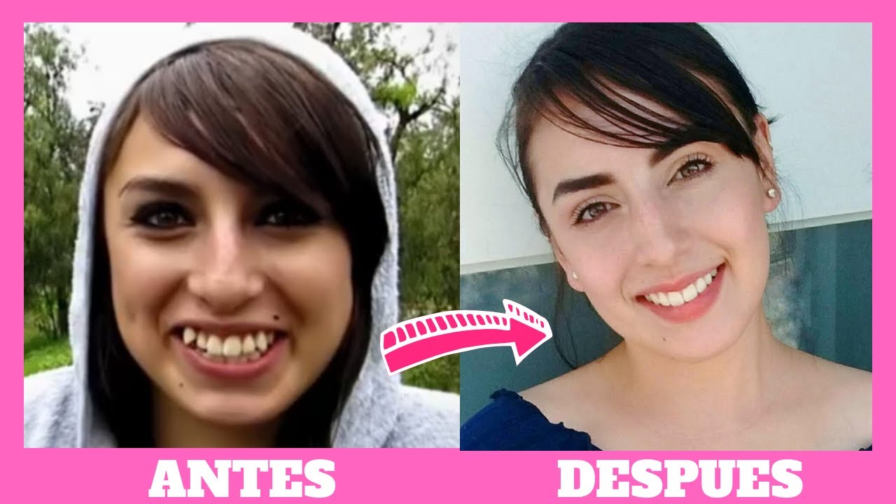 4 AÑOS CON BRACKETS ¡¡ por fin me los quitan !! 😬