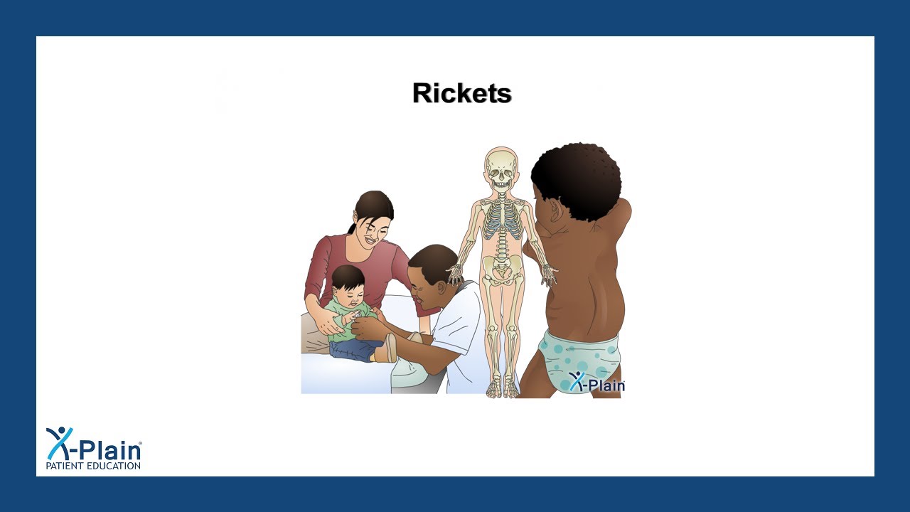 Rickets