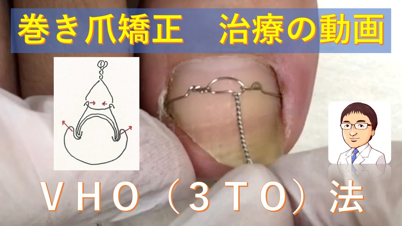 巻き爪　３ＴＯ（ＶＨＯ）法による巻き爪矯正：巻き爪・陥入爪治療の相談室  Ingrown Toenails   3TOVHO wire method