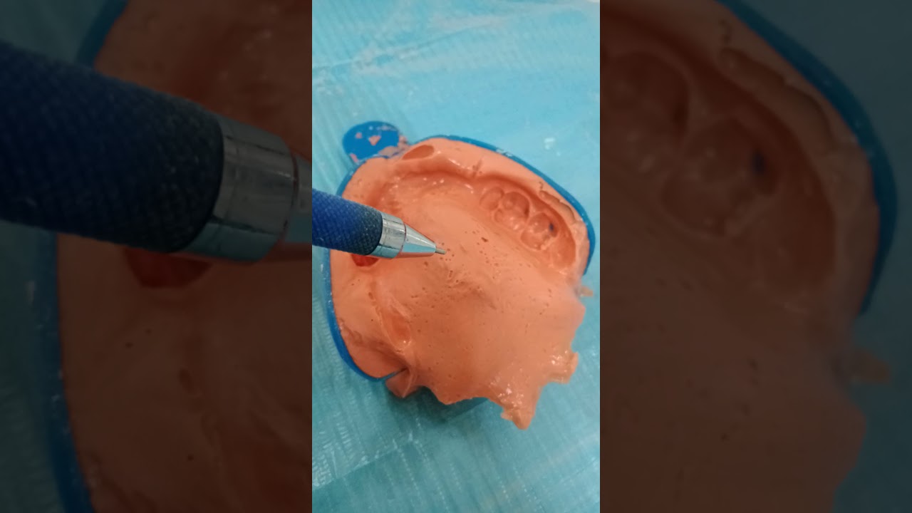 Visit 1: Primary impression critique. Solutions for lip and tongue traps