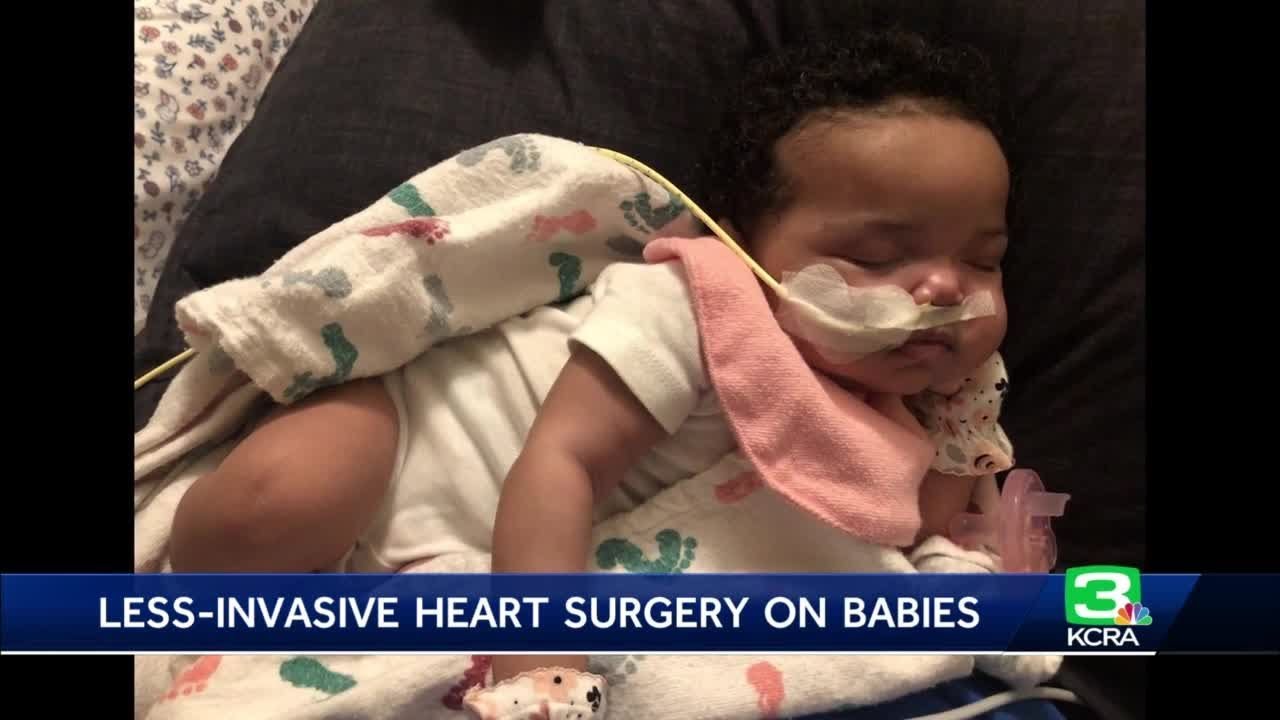 Pioneering surgical technique helps save lives of 2 babies born in Sacramento