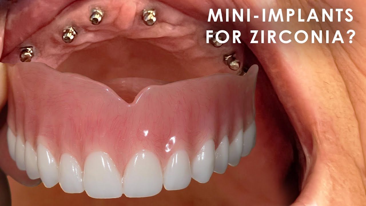 Are Mini-Implants Good for Full-Mouth Zirconia?