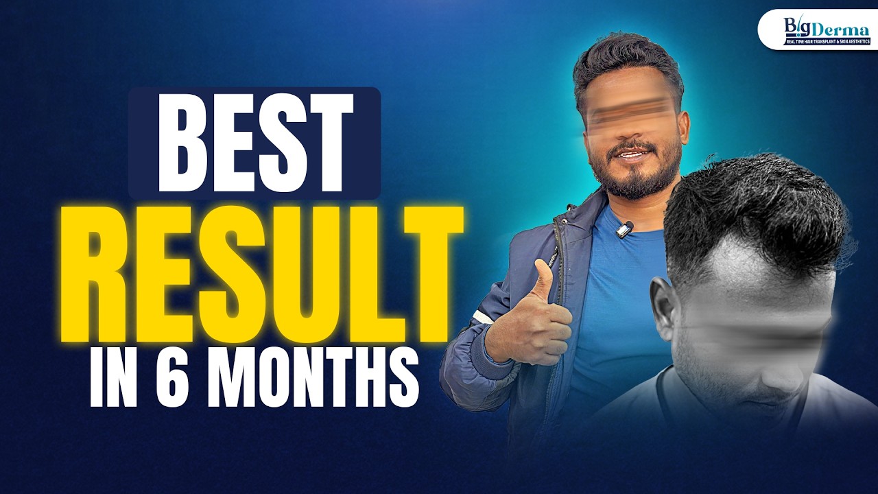 Best Hair Transplant Result in 6 Months | Real Patient Transformation 💯