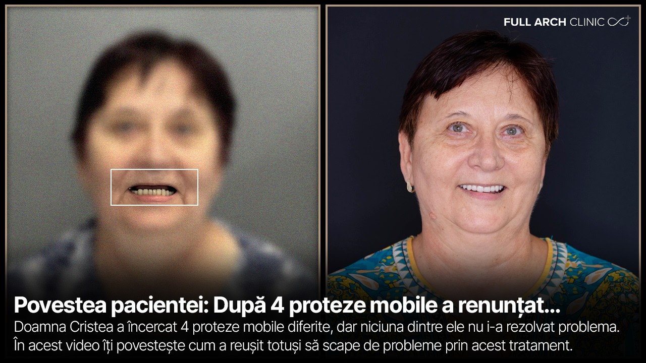 De la Proteza Mobila la Implanturi Dentare - Cat de Mare este Diferenta