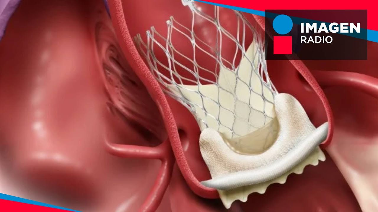 ¿Qué puede provocar el transplante de la válvula aórtica?