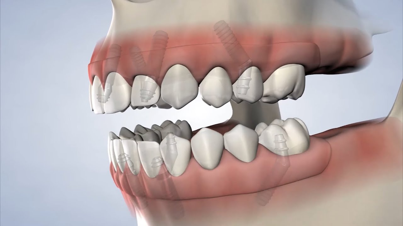 Full-Arch Replacement in Waco TX | Brazos Oral & Facial Surgery