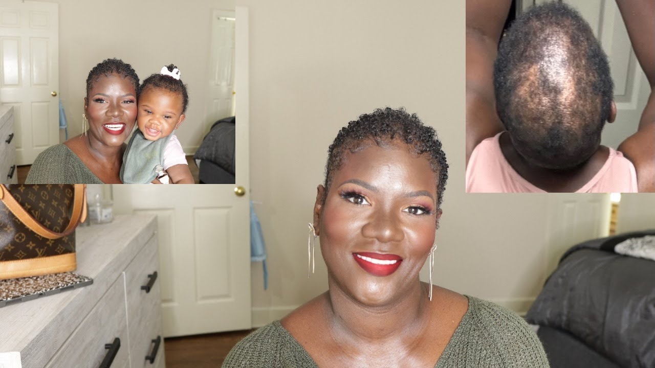 CCCA ALOPECIA HAIR AND LIFE UPDATE