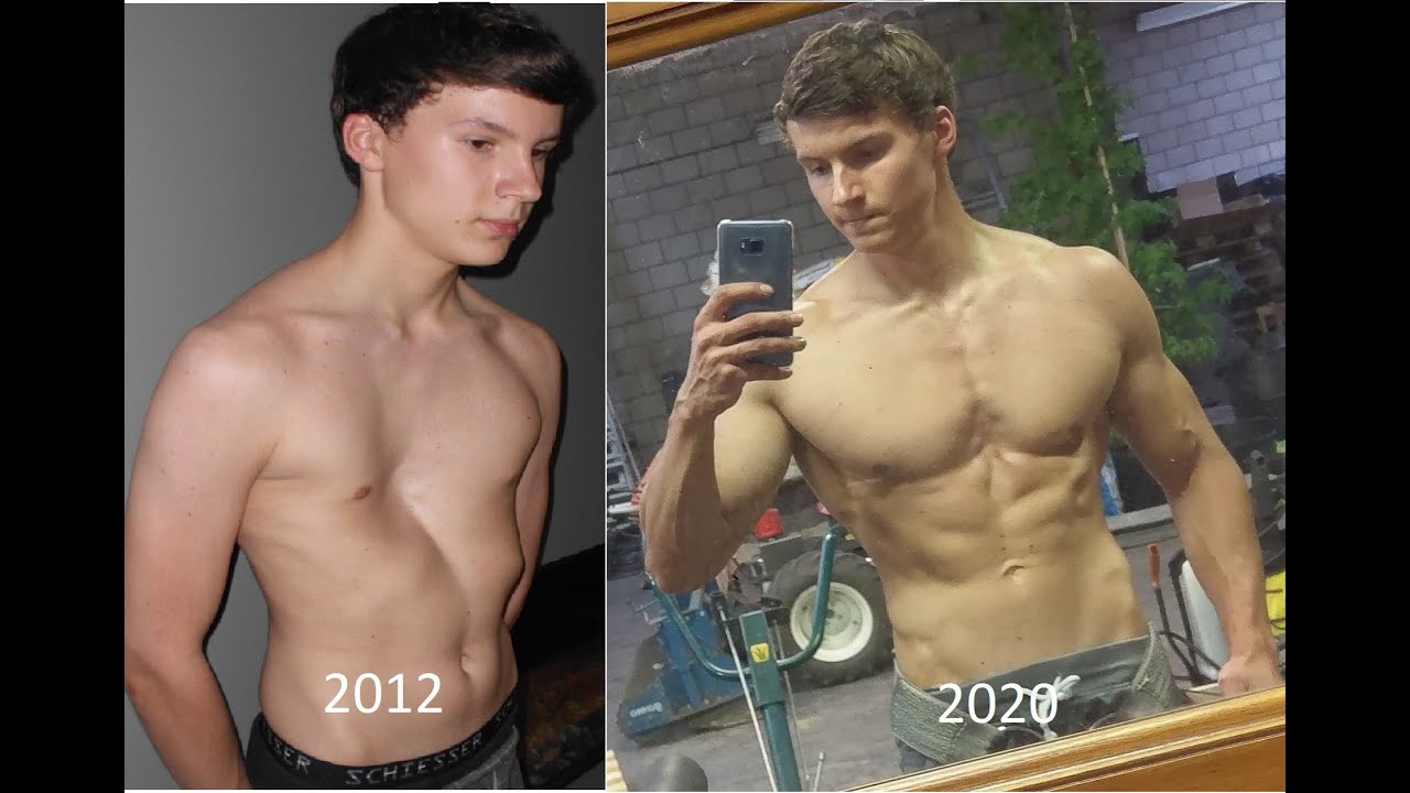 My Body Transformation Street Workout & Pectus Excavatum